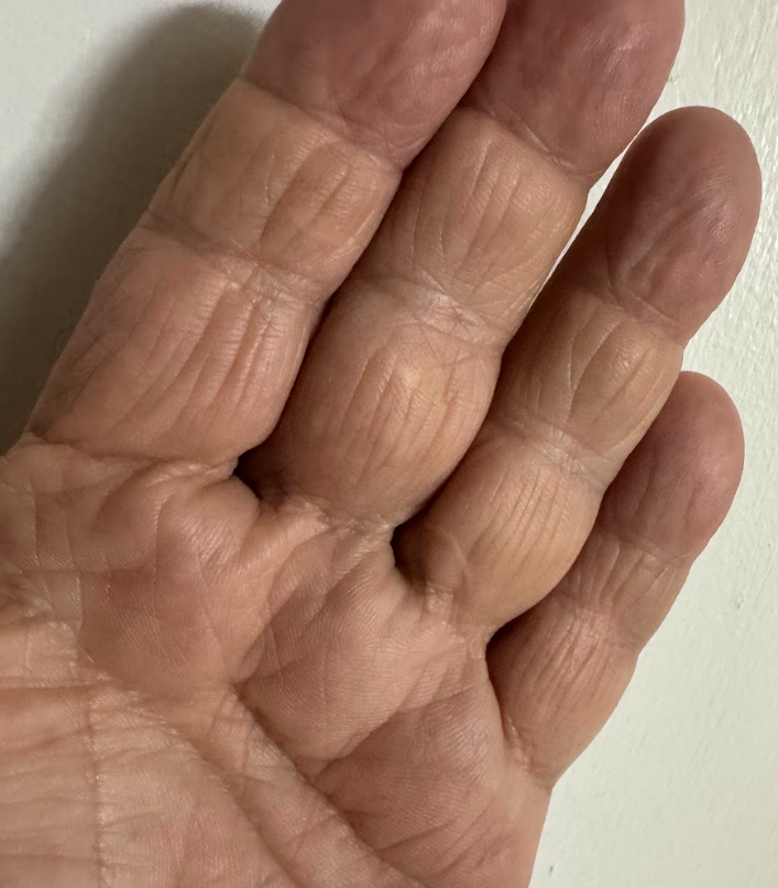 Advanced Palmar Reconstruction